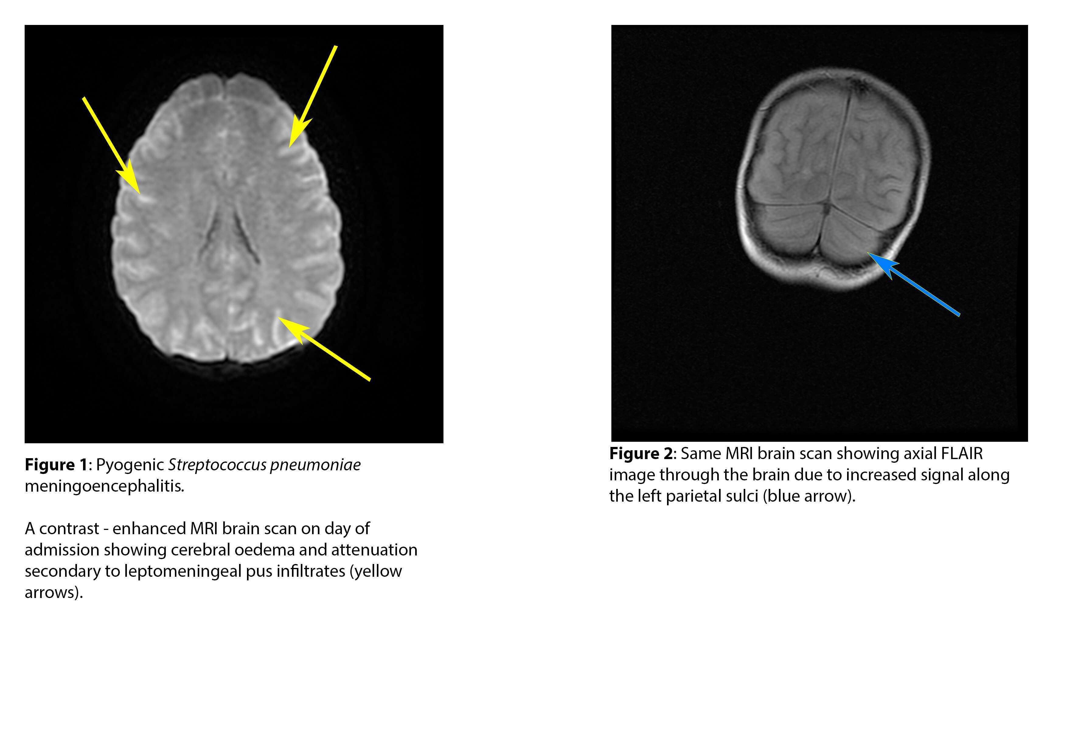 MRI Brain scans showing pyogenic meningoencephalitis